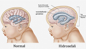Her birey hidrosefali riski taşıyor!